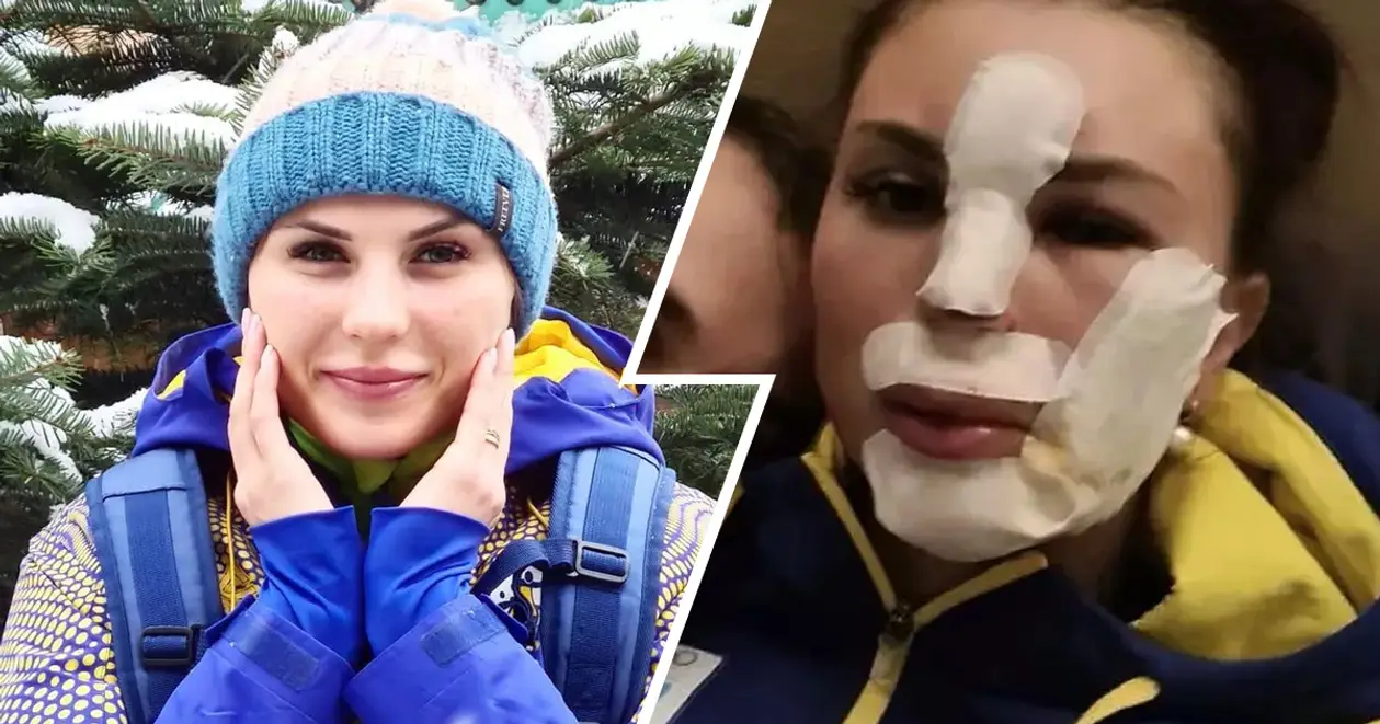 Украинская биатлонистка серьезно травмировала лицо на лыжероллерной трассе. Фото не для слабонервных