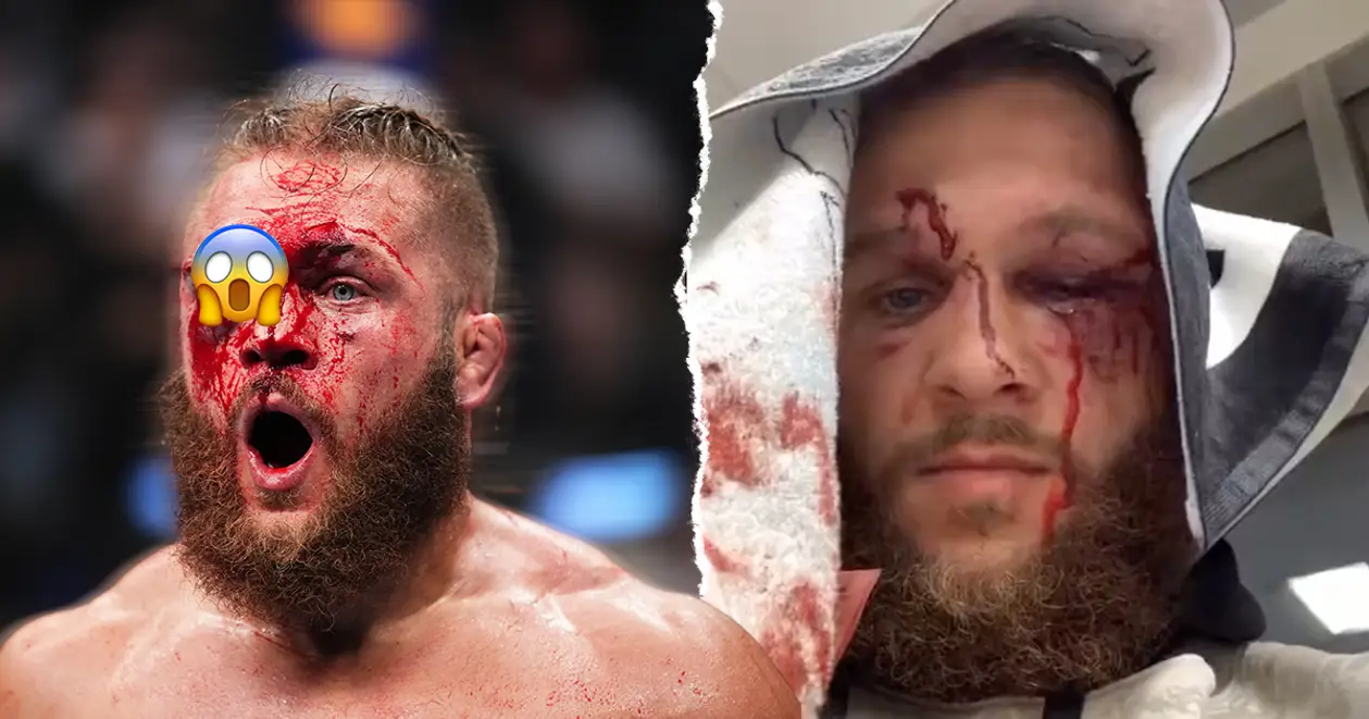 Обличчя Фізієва після поєдинку на UFC у Лондоні – 😲 Виглядає жорстко
